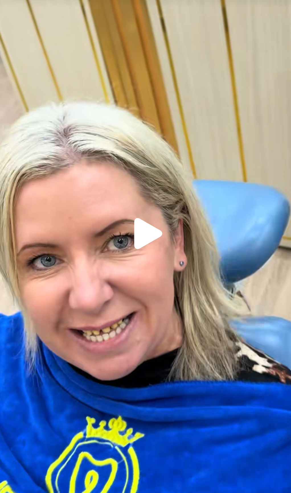 Patient 2: the same preparation pattern. Circumferential reduction of upper and lower anterior teeth to stubs.