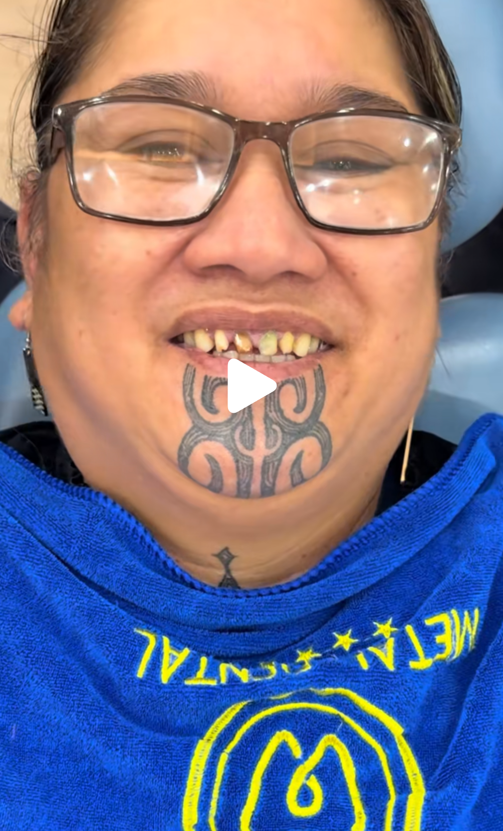 Patient 3: a third patient showing the identical preparation pattern. Upper anterior teeth reduced to stubs. The Metal Dental bib is visible. The pre-treatment teeth in this patient showed the same discolouration and alignment presentation as patients 1 and 2 — the same veneer indication, the same full-coverage crown response.