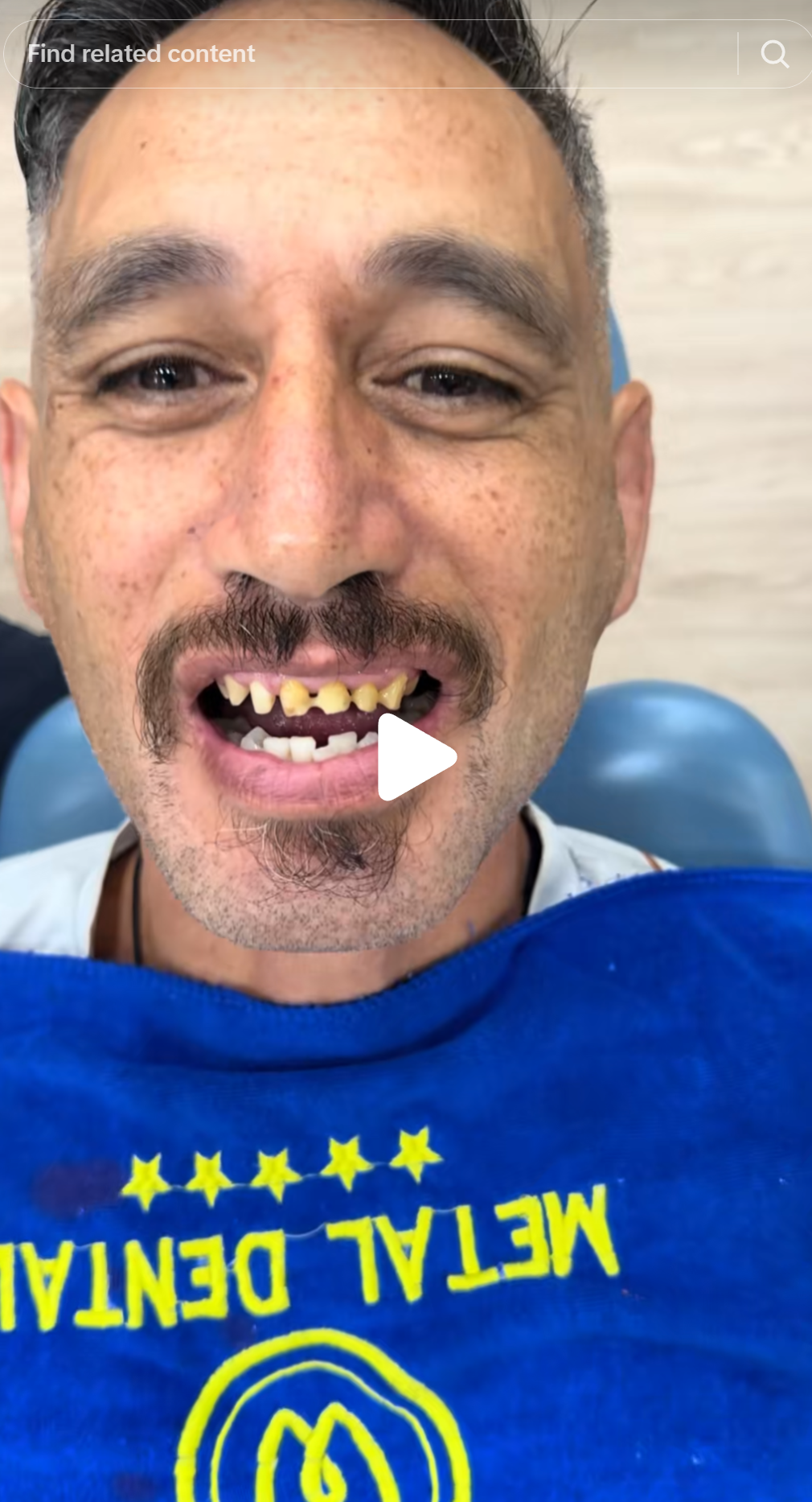Patient 4: upper and lower anterior preparations visible. Four patients, documented in the clinic's own publicly published video content, all showing the same pattern: healthy-enough teeth ground down to stubs to fit full-coverage crowns. This is not a single clinical error. It is a treatment protocol.