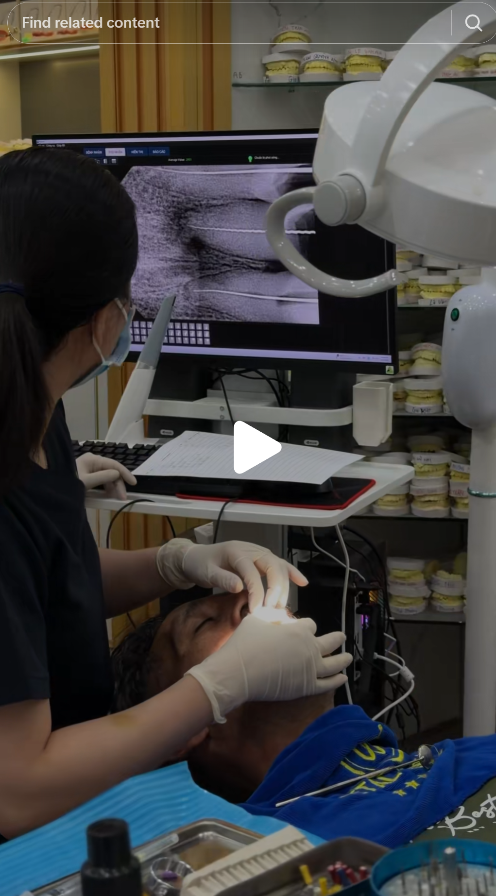 Root canal treatment in progress at Metal Dental Clinic. A periapical radiograph is visible on the monitor. The operator is working on the patient. At the fee point advertised in the promotional content — equivalent to AUD 15–20 — a molar root canal cannot be performed to standard. Working length determination, rotary canal shaping, hypochlorite irrigation at volume, and verified obturation each take time. The fee does not support that time.